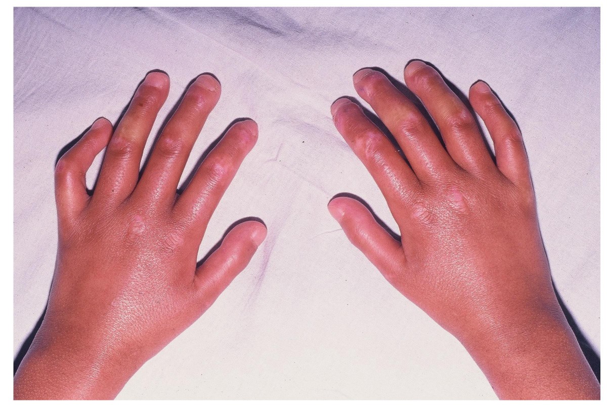 Systemic Sclerosis Symptoms