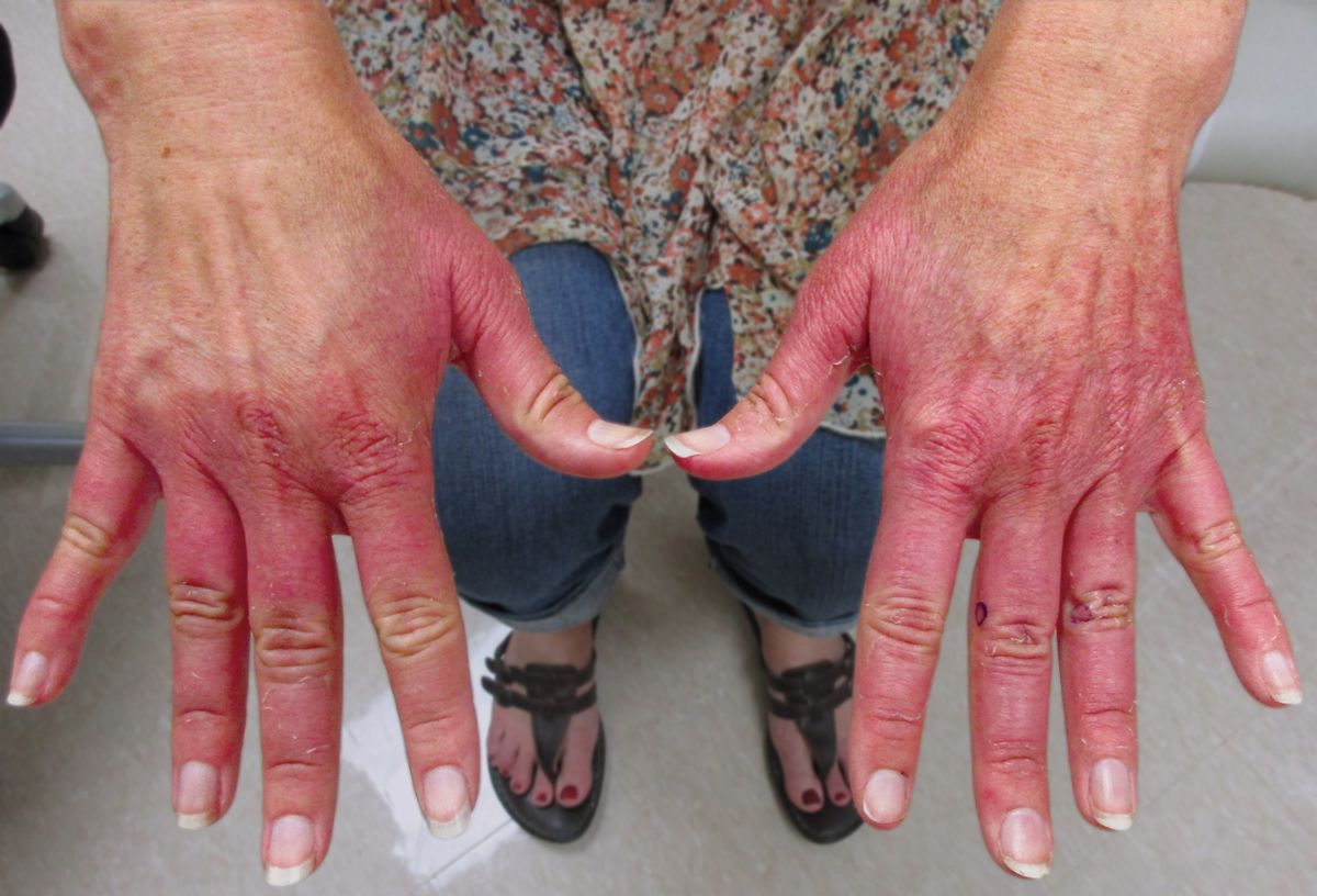 Mixed Connective Tissue Disease