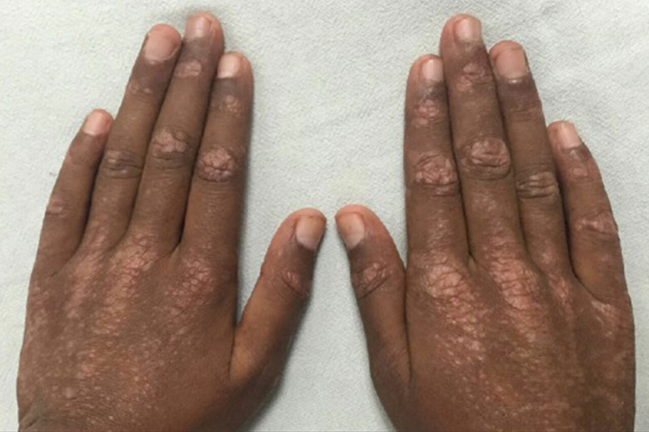 Dermatomyositis Symptoms