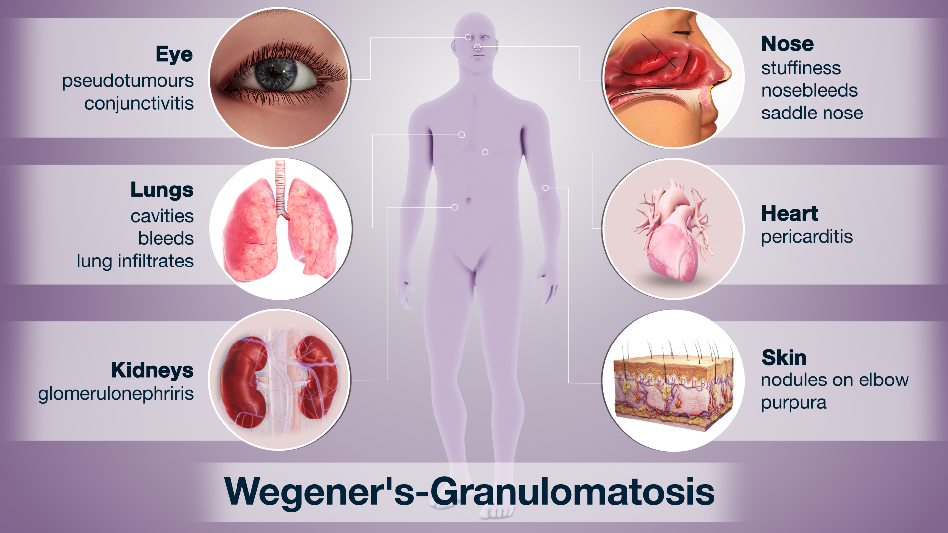 Vasculitis Wegener’s MPA