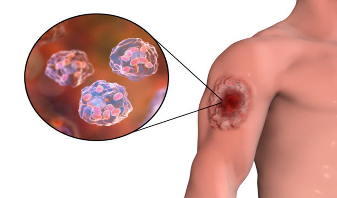 Living with Vasculitis