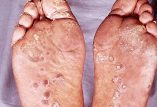 Reactive Arthritis - Iris Clinics