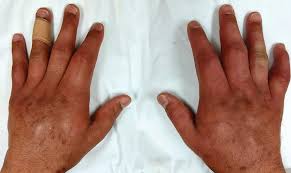 Mixed Connective Tissue Disease - Iris Clinics