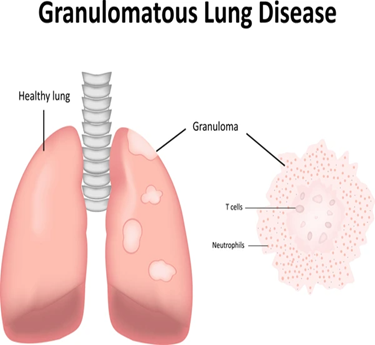 Wegener's Granulomatosis & Microscopic Polyangiitis treatment in trivandrum