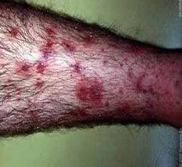 Henoch-Schonlein purpura specialist