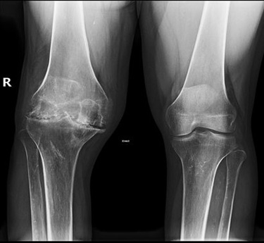 Haemophilic arthropathy treatment in trivandrum
