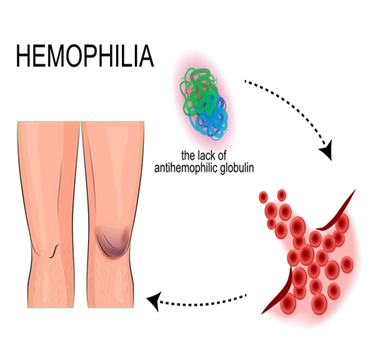 Haemophilic arthropathy specialist
