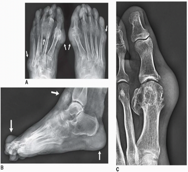 Metabolic Arthropathies treatment in trivandrum