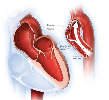 Takayasu's Arteritis specialist image