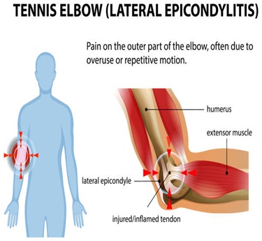 Lateral Epicondylitis (Tennis Elbow) treatment in trivandrum