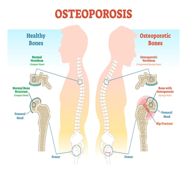 Osteoporosis treatment in trivandrum
