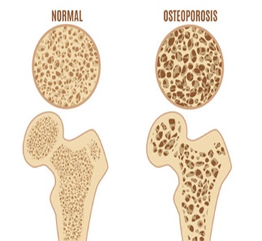 Osteoporosis specialist