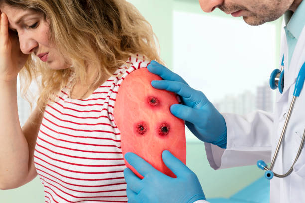 Wegener's Granulomatosis & Microscopic Polyangiitis symptoms