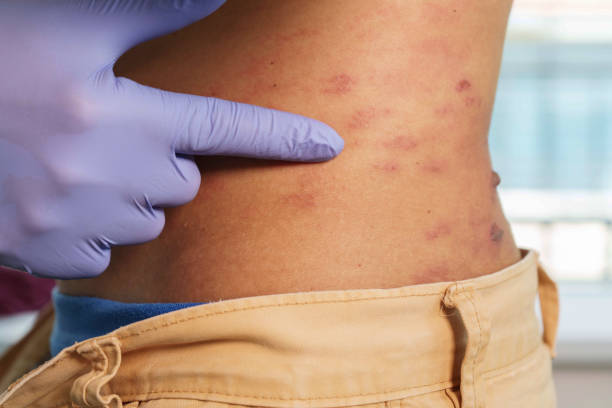 Henoch-Schonlein purpura symptoms