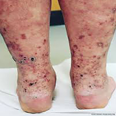 Polyarteritis Nodosa