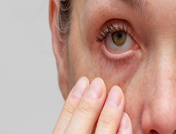 Sjogren’s Syndrome