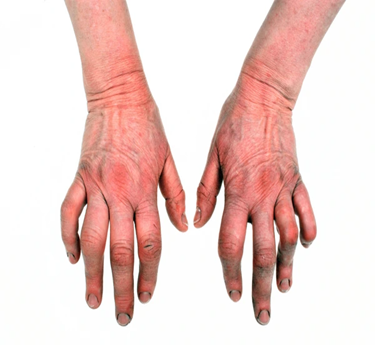 Psoriatic Arthritis treatment in trivandrum