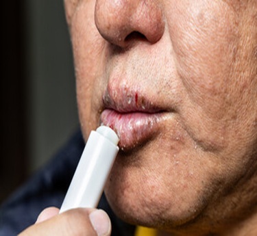 Sjogren Syndrome treatment in trivandrum