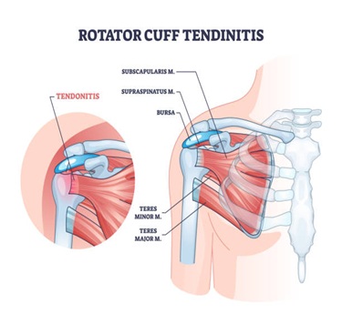 Rotator Cuff Tendinitis treatment in trivandrum