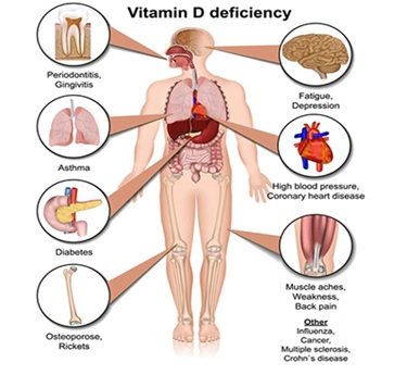 Osteomalacia and Vitamin D Deficiency treatment in trivandrum